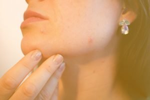 rostro con granos seborreicos